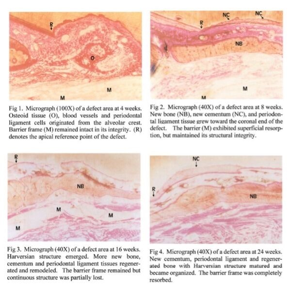 Cytoflex Resorb