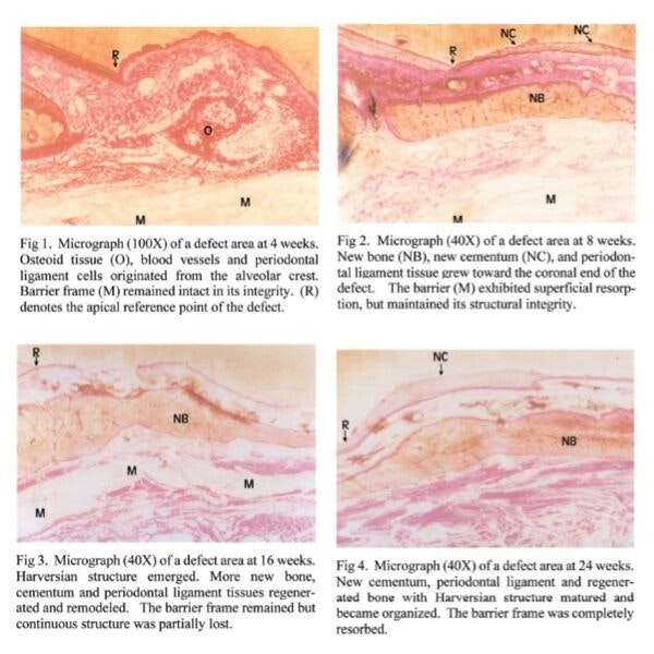 cytoflex resorb case 2