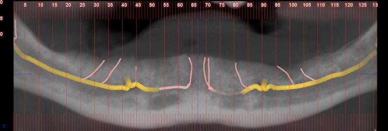 incisive canal mandible