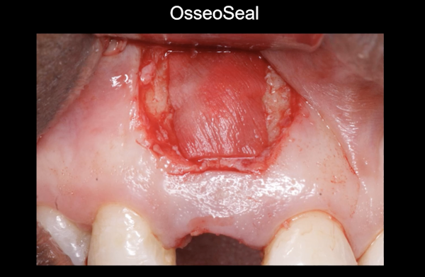 osseoseal case