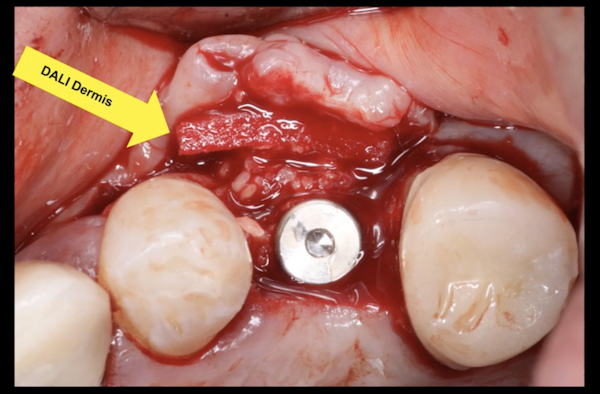 dali-dermis-membrane