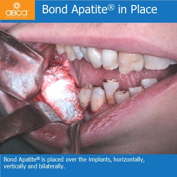 Bond apatite over implants