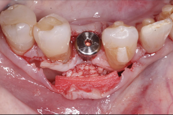 Dali Cortical Cancellous Graft with ADM