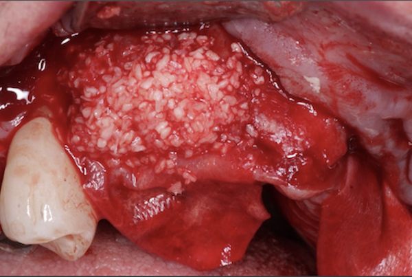 Dali Cortical Cancellous Graft with Osseoseal