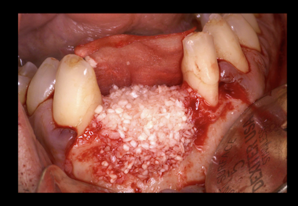 Dali Cortical Cancellous Graft