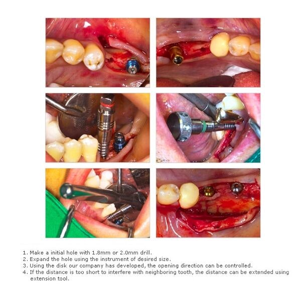 Bone Expander Kit Case