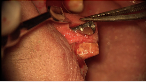 Osteogen Strip Surgery Implant