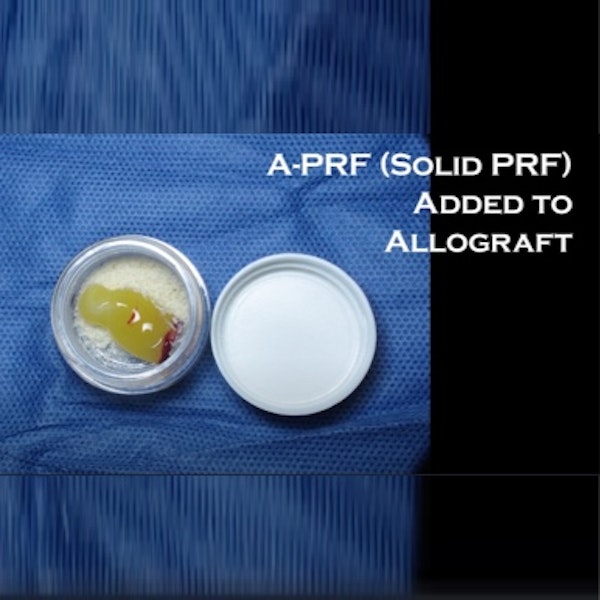 Solid PRF added to Allograft