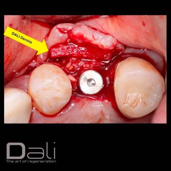 DALI Dermis Case Implant