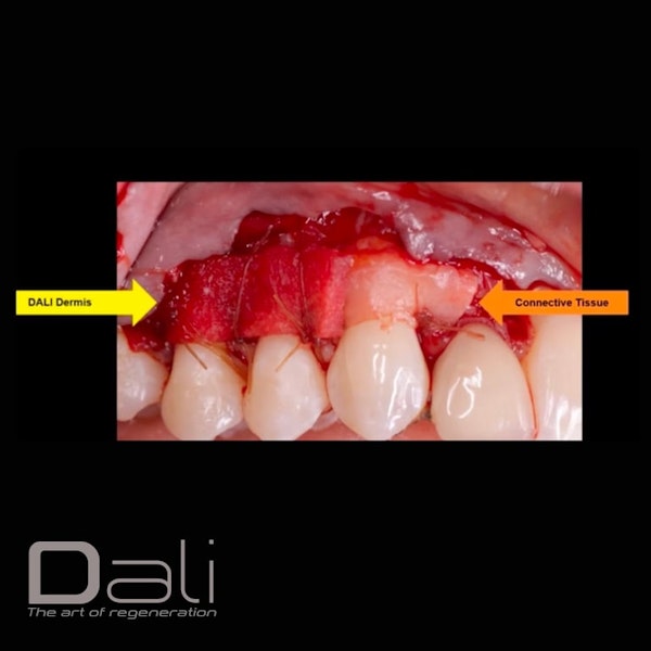 DALI Dermis Connective Tissue