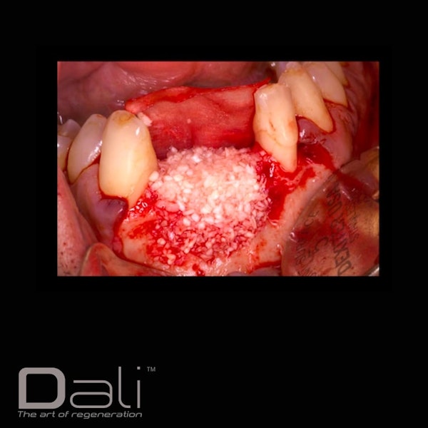 DALI Cortical Cancellous Case