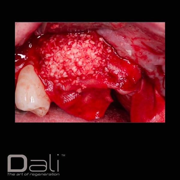 DALI Cortical Cancellous with Membrane