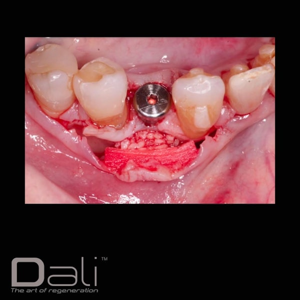 DALI Cortical Cancellous with OsseoSeal