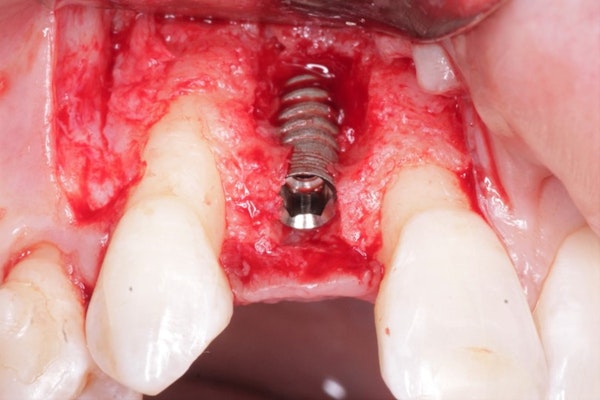 osseoseal implant