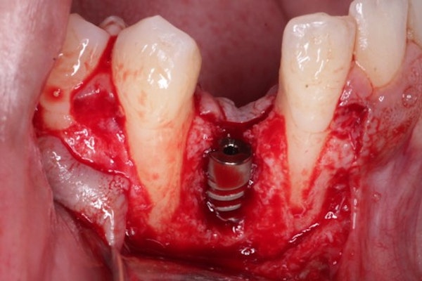 implant site
