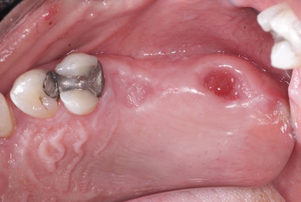 oral-antral communication 1