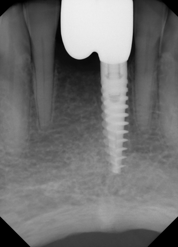 two-implants-or-one