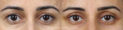 Blepharoplasty/NatraEye Before & After Gallery - Patient 37901866 - Image 1