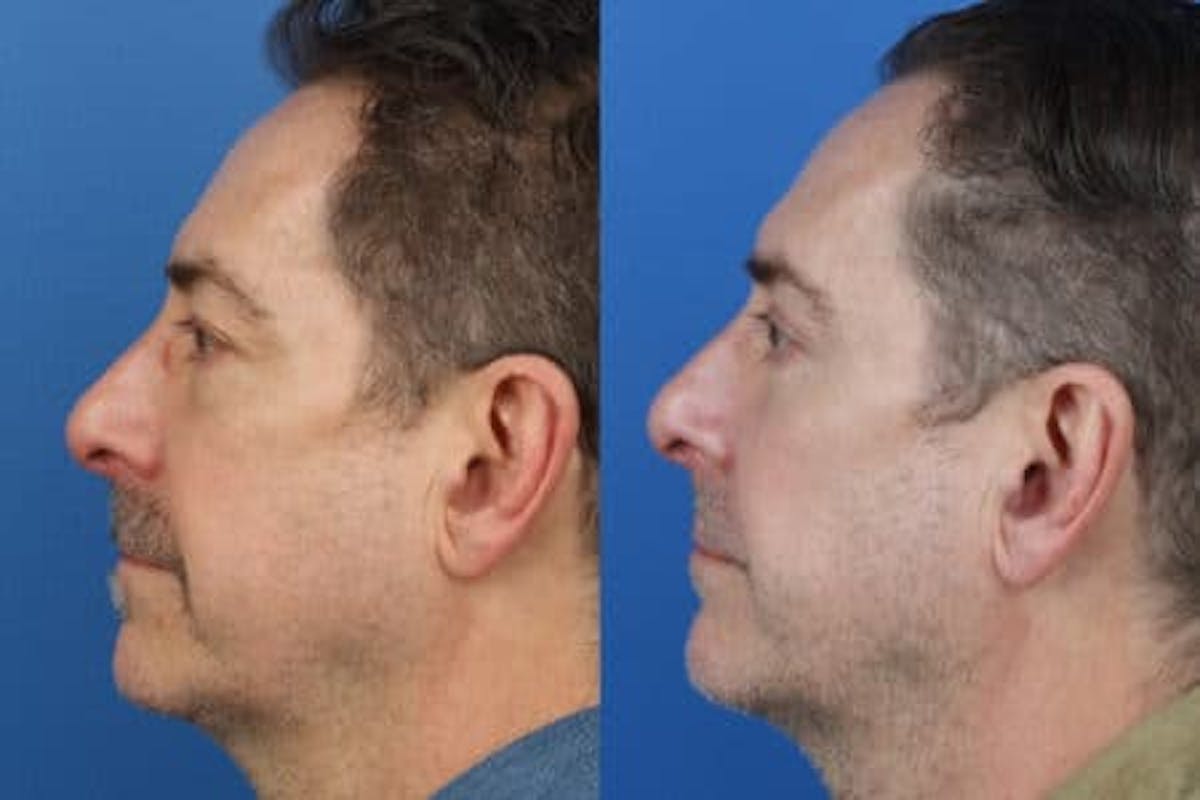 Blepharoplasty/NatraEye Before & After Gallery - Patient 37901867 - Image 2