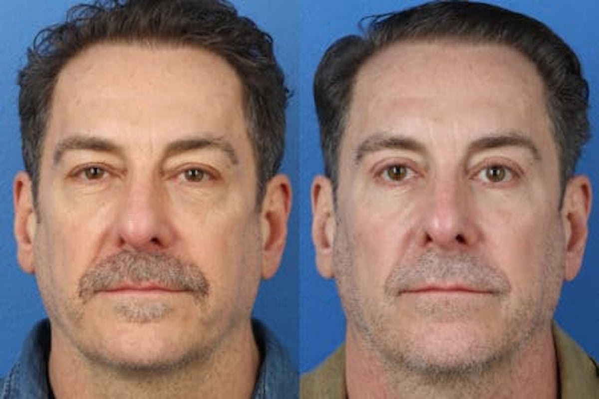 Blepharoplasty/NatraEye Before & After Gallery - Patient 37901867 - Image 3
