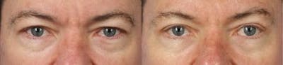 Blepharoplasty/NatraEye Before & After Gallery - Patient 37901870 - Image 1