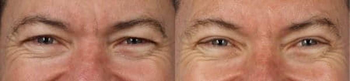 Blepharoplasty/NatraEye Before & After Gallery - Patient 37901870 - Image 2