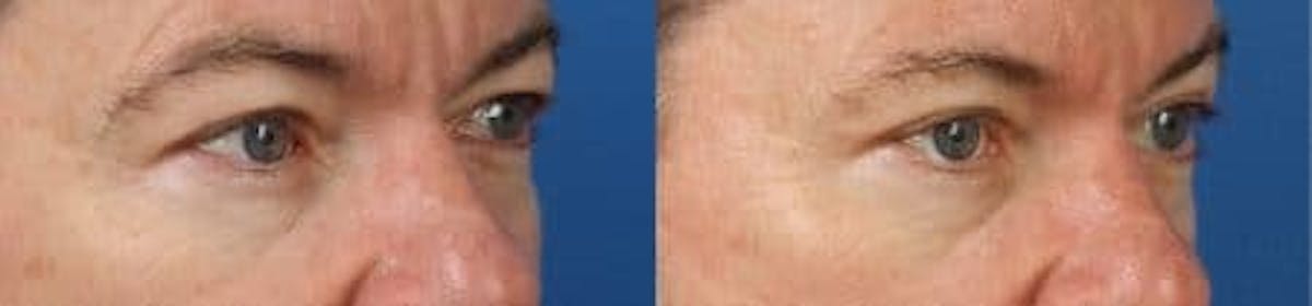 Blepharoplasty/NatraEye Before & After Gallery - Patient 37901870 - Image 3