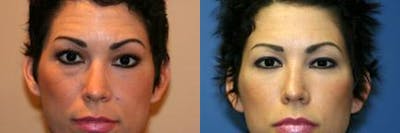 Blepharoplasty/NatraEye Before & After Gallery - Patient 37901896 - Image 1