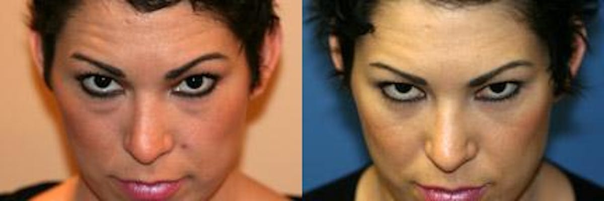 Blepharoplasty/NatraEye Before & After Gallery - Patient 37901896 - Image 2