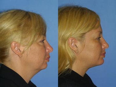 Blepharoplasty/NatraEye Before & After Gallery - Patient 37901903 - Image 1