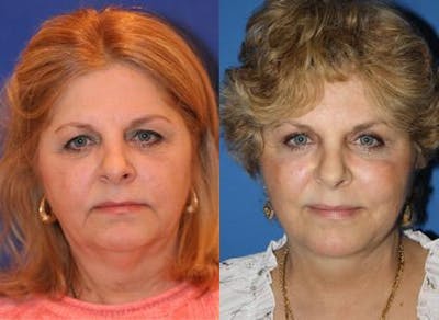 Blepharoplasty/NatraEye Before & After Gallery - Patient 37901909 - Image 1