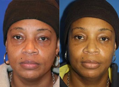 Blepharoplasty/NatraEye Before & After Gallery - Patient 37901915 - Image 1