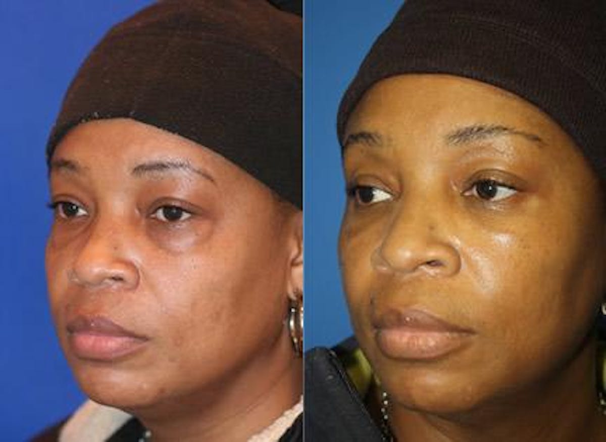 Blepharoplasty/NatraEye Before & After Gallery - Patient 37901915 - Image 2