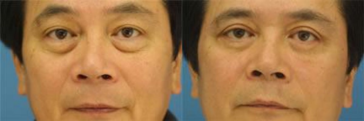 Blepharoplasty/NatraEye Before & After Gallery - Patient 37901922 - Image 1