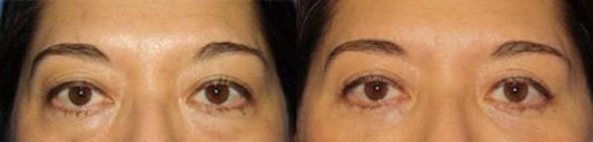 Blepharoplasty/NatraEye Before & After Gallery - Patient 37901928 - Image 1
