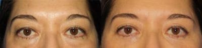 Blepharoplasty/NatraEye Before & After Gallery - Patient 37901928 - Image 1