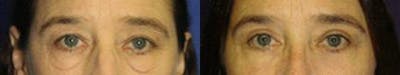 Blepharoplasty/NatraEye Before & After Gallery - Patient 37901933 - Image 1