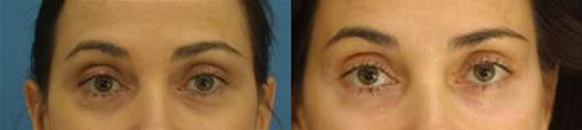 Blepharoplasty/NatraEye Before & After Gallery - Patient 37901937 - Image 1