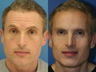 Botox Before & After Gallery - Patient 37901982 - Image 1