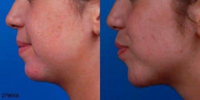Botox Before & After Gallery - Patient 37901990 - Image 1