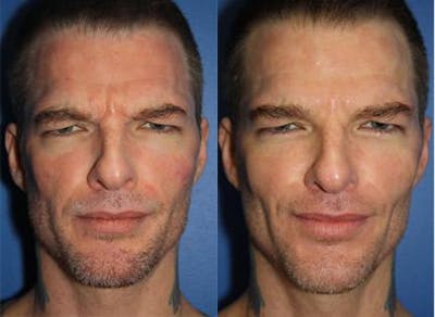 Botox Before & After Gallery - Patient 37901995 - Image 1
