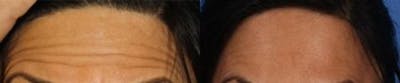 Botox Before & After Gallery - Patient 37901999 - Image 1