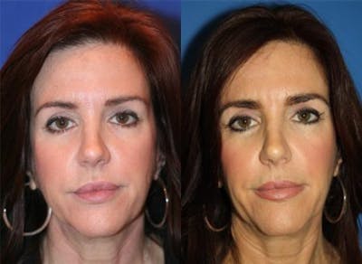 Botox Before & After Gallery - Patient 37902005 - Image 1