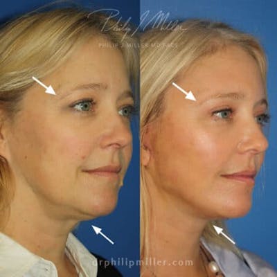 Browlift Before & After Gallery - Patient 37902094 - Image 1