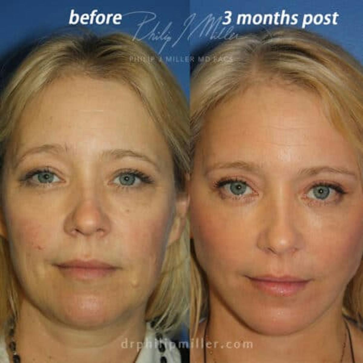 Browlift Before & After Gallery - Patient 37902094 - Image 2