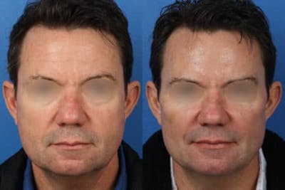 Browlift Before & After Gallery - Patient 37902106 - Image 1
