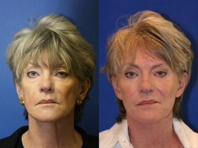 Browlift Before & After Gallery - Patient 37902111 - Image 1