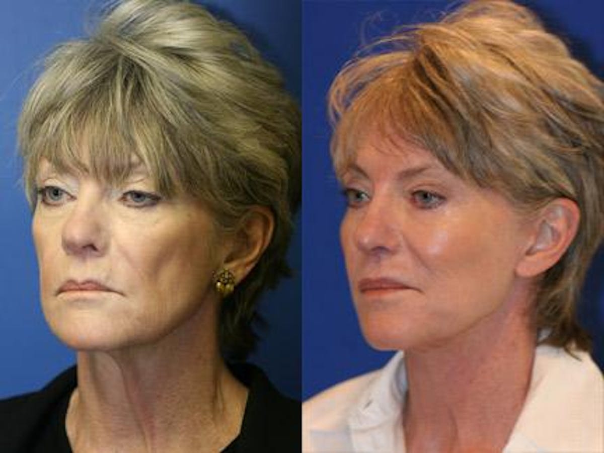 Browlift Before & After Gallery - Patient 37902111 - Image 2