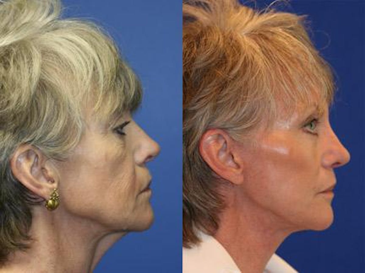 Browlift Before & After Gallery - Patient 37902111 - Image 3