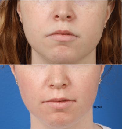 Buccal Fat Removal Before & After Gallery - Patient 37902128 - Image 1